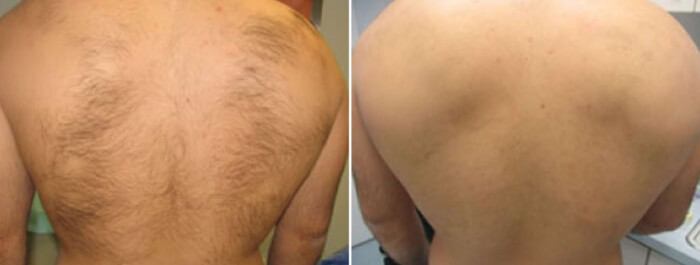 Фото до и после эпиляции спины